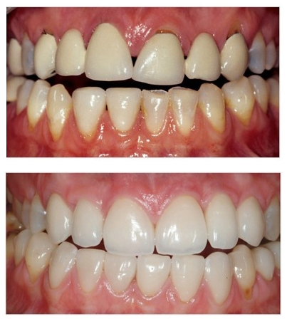 Depigmentation of Gums