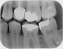 Dental X-Ray