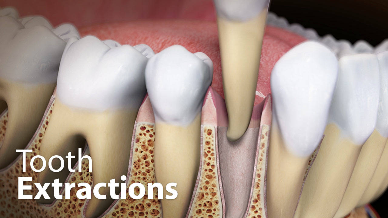 Impaction Tooth Extraction