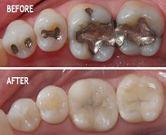 Dental Restoration